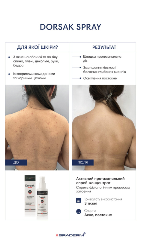 Активний протизапальний спрей-концентрат для шкіри з Акне Braderm DORSAK SPRAY, 100 мл