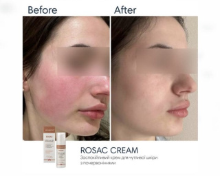 Заспокійливий крем для чутливої шкіри з Розацеа та куперозом Braderm ROSAC CREAM, 30 мл